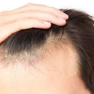Ursachen Haarausfall - Dr. med. Philippi - Praxis für ästhetische Medizin Rosenheim